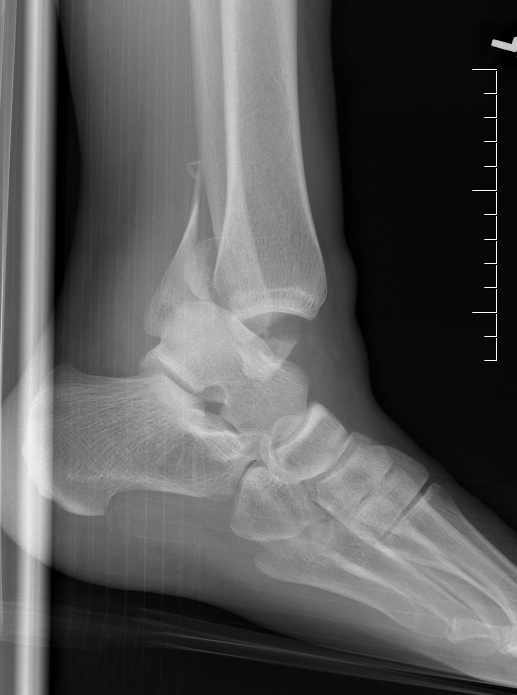 Dislocated Ankle Lateral